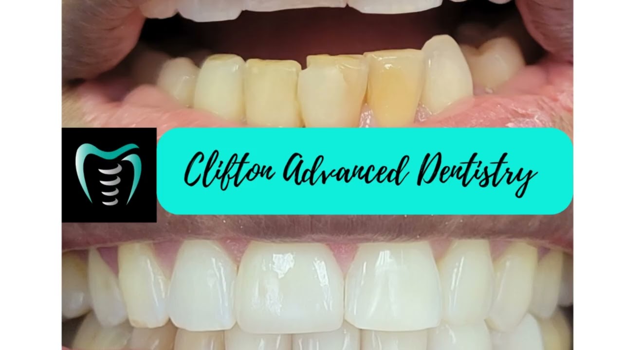 Smile Makeover in Clifton, NJ: Dental Implants, Veneers & Emergency Care