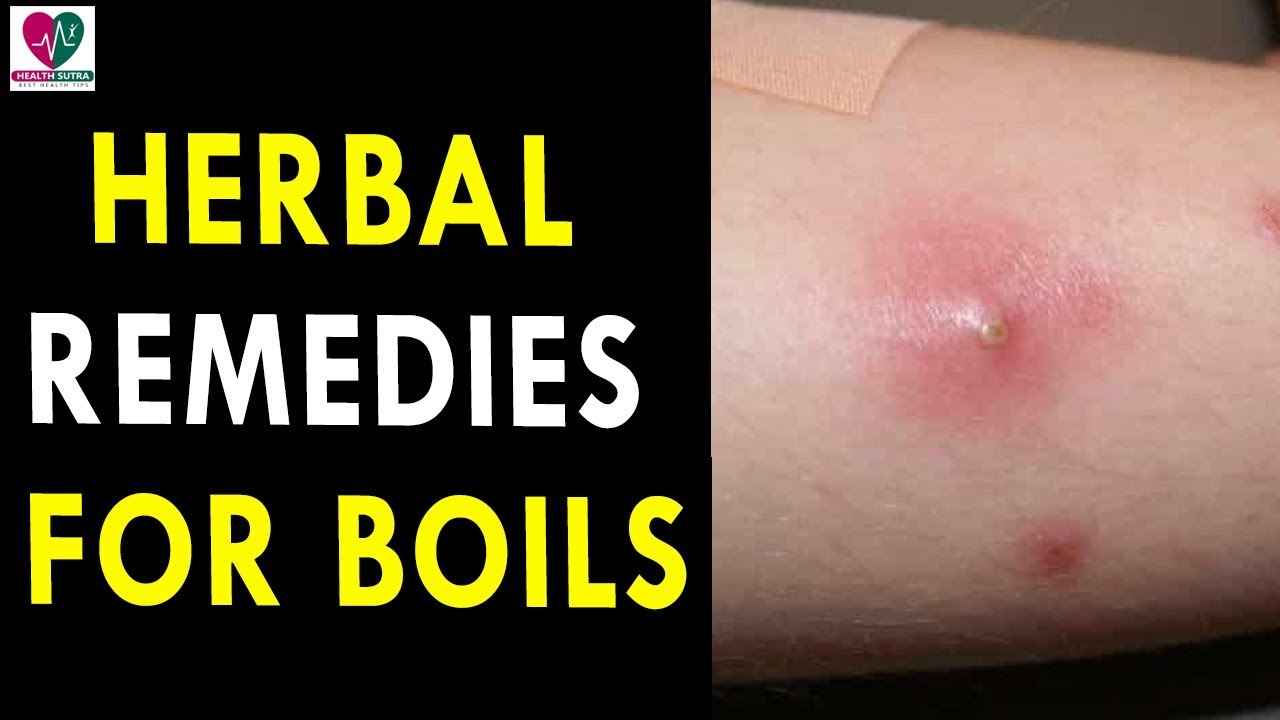Herbal Remedies for Boils Health Sutra Best Health Tips YouTube