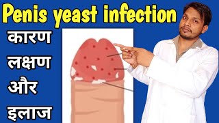 penis yeast infection cause, symptoms, treatment || Balanitis || ling me infection hone ke karan