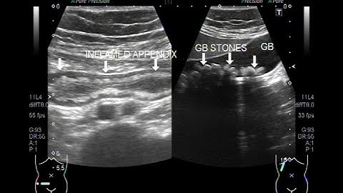 Ultrasound Video showing the Inflamed Appendix and Cholelithiasis.