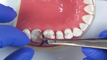 Verbeter de plaatsing van uw matrixband met deze snelle tip