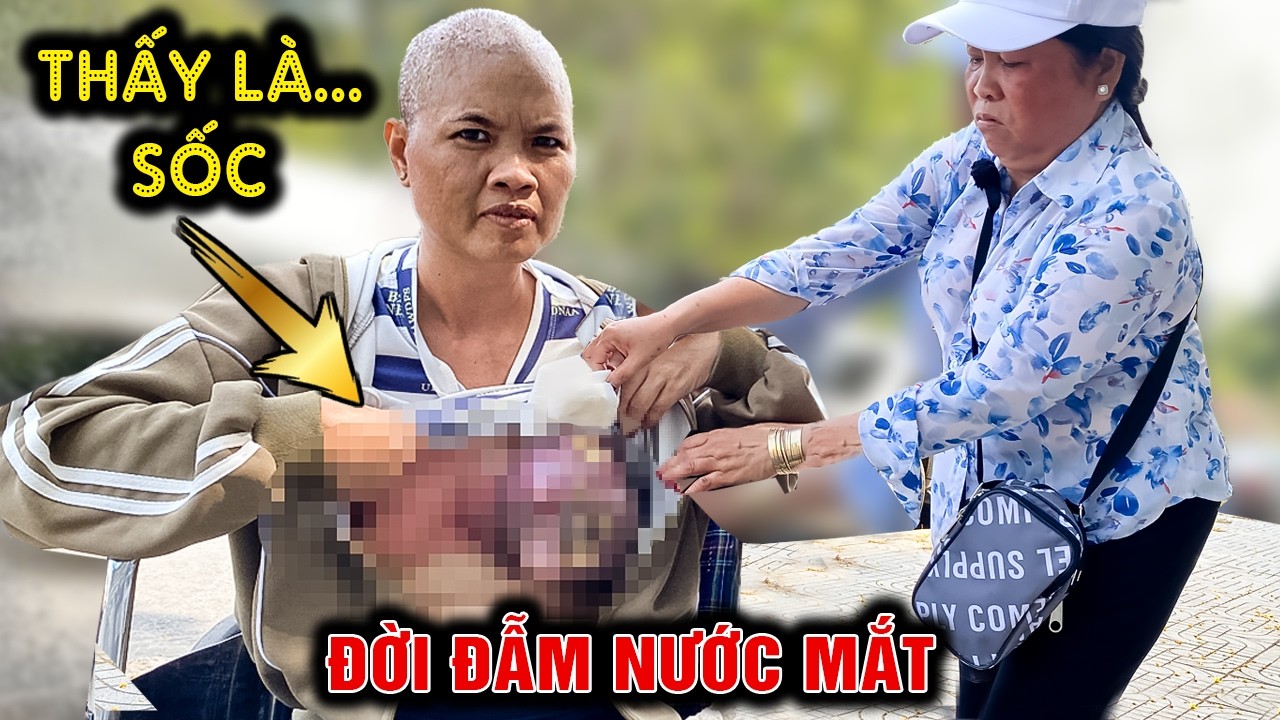 🔴 Hiếm có: người dưng giúp chị gái u 'vòng 1' đen quá khiếp & nỗi niềm thầm kín