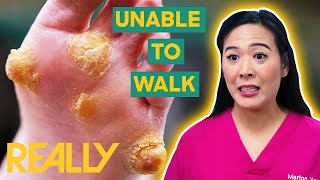 Toe Removal Brings Instant Relief To Patient's Pain | The Bad Foot Clinic | Brand New Series