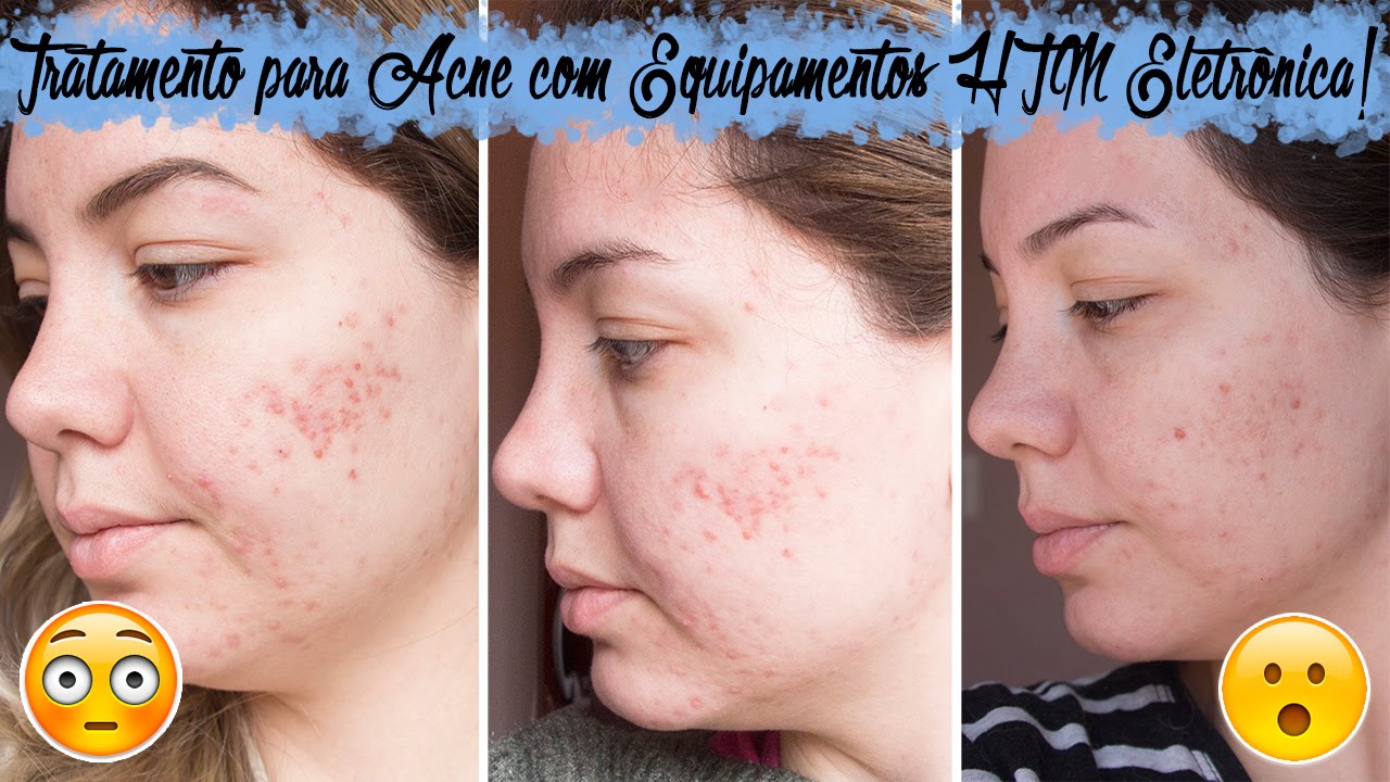 Acne quitar por para tratamiento manchas