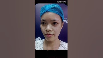 Nâng Mũi Cấu Trúc Sline - Cao Thon Gọn, Đẹp Tự Nhiên Sau 20 Ngày