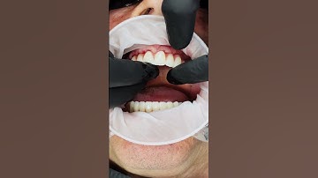 Dental Implants: See the Shocking Before & After Transformation!