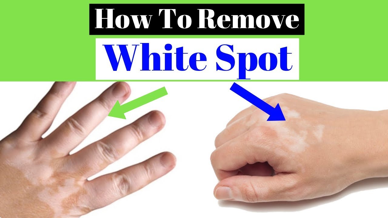 White Spots On Skin Best 4 Remedies To Treat It Youtube