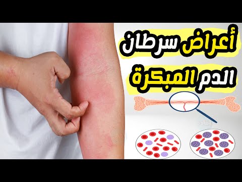 أعراض سرطان الدم المبكرة