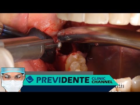 Vídeo: Cisto De Dente (na Raiz) - Causas E Sintomas, Remoção Do Cisto Na Raiz Do Dente (operação)