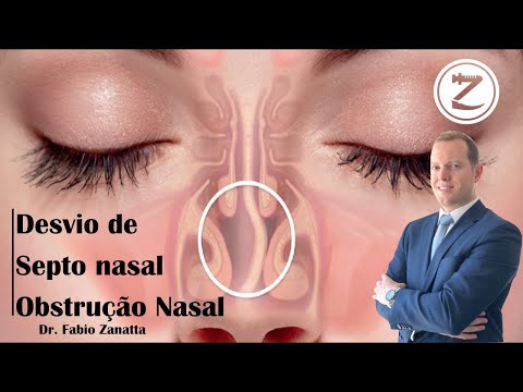 Vídeo: Curvatura Do Septo Nasal - O Que Fazer?