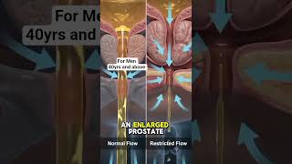 5 warning SIGNS of PROSTATE CANCER Every MAN Over 40 Should Know