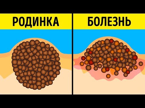 9 Мифов о Родинках и Загаре, в Которые Давно Пора Перестать Верить