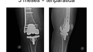 Caso clínico 8: Fracturas de fémur distal