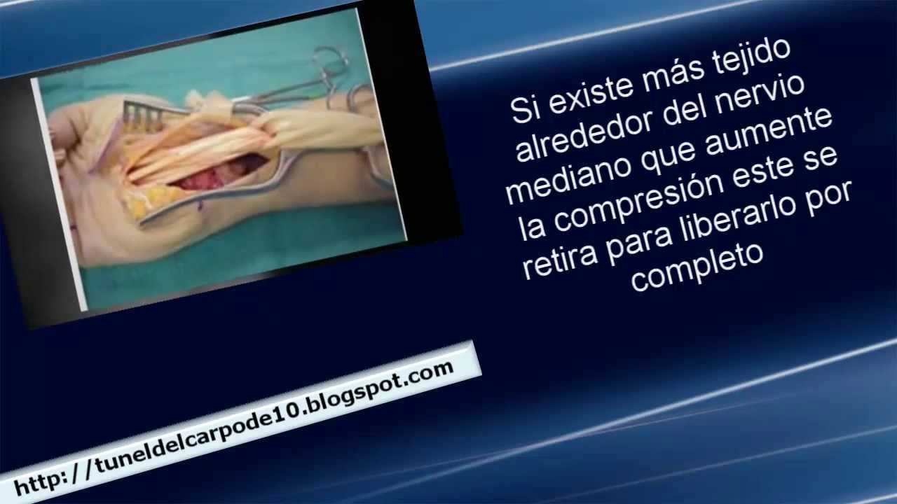 Operacion Del Tunel Carpiano Cirugia De Mano Y Carpo Youtube