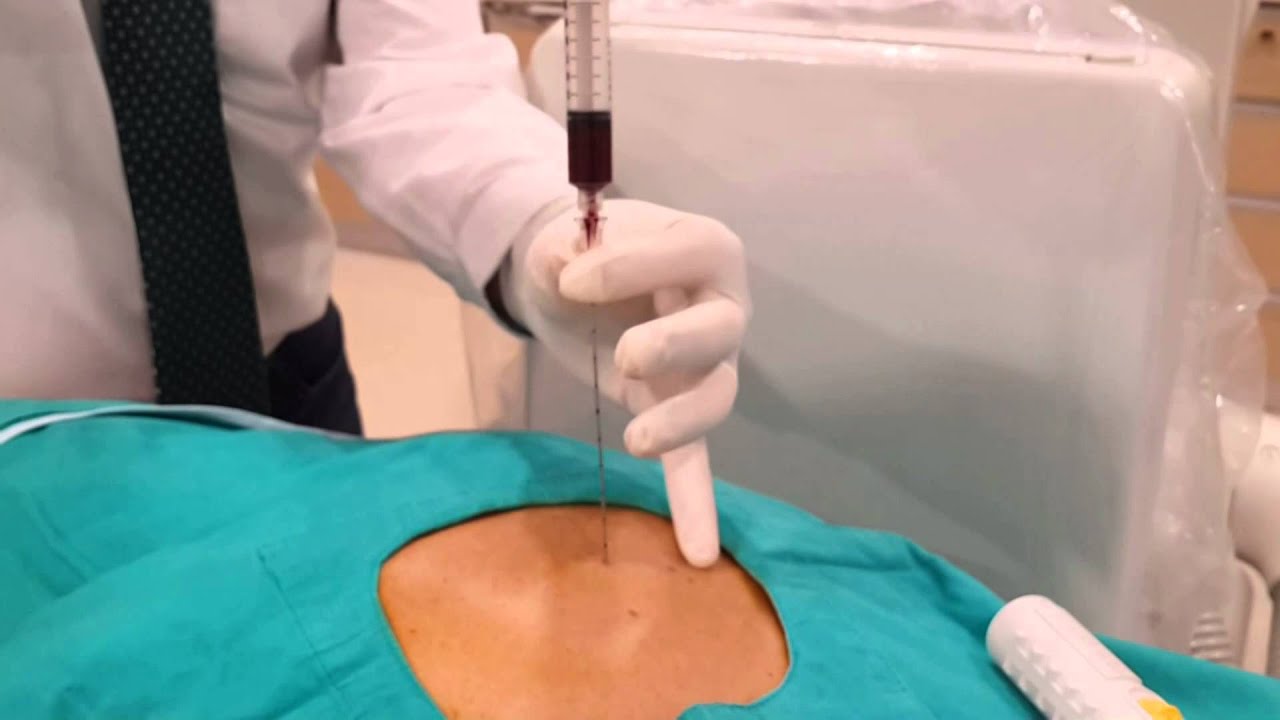 Percutaneous Lung Biopsy Youtube