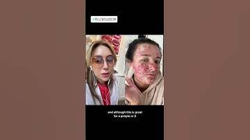 Hydrocolloid Patches #shorts