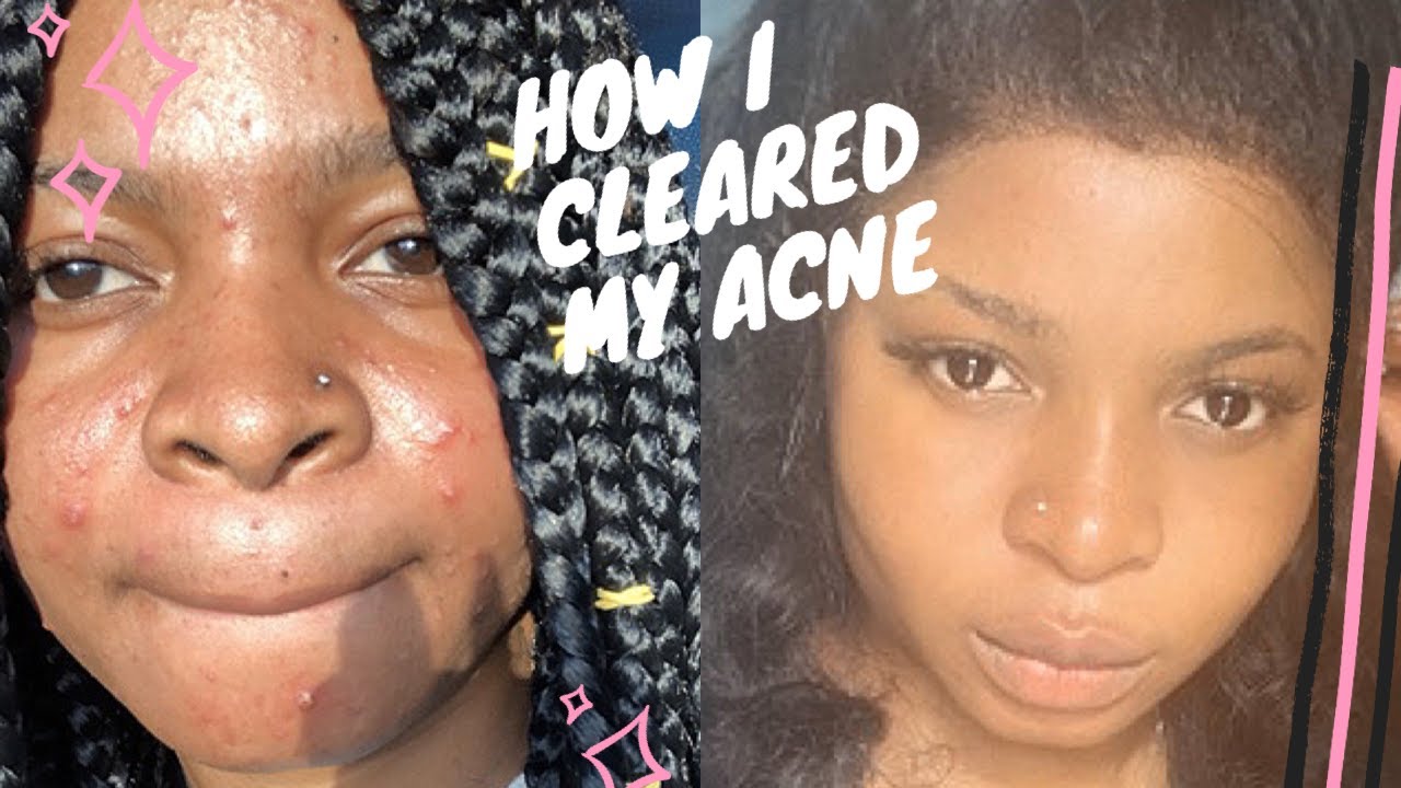 HOW I GOT RID OF MY ACNE|ACNE SYSTEM THAT CHANGED MY LIFE- Clear proof ...