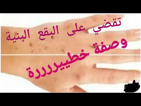 أم شاهين وصفة مذهلة للتخلص من البقع و التصبغات البنية الداكنة على اليدين