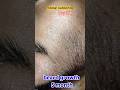 beard growth#minoxidil #mars #beardgrowth #minoxidil5 #marsbyghc