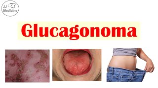 Why a Rash, Diabetes, and Weight Loss Can Point to One Rare Tumor - Glucagonoma