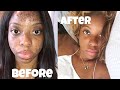 AFRICAN BLACK SOAP ✨ | HOW I CLEARED MY ACNE & DARK SPOTS!! W/ HAVING CHRON’S DISEASE