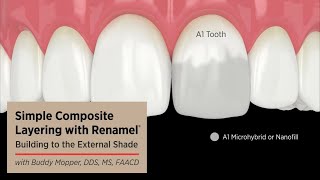 Color-matching with Dental Composite