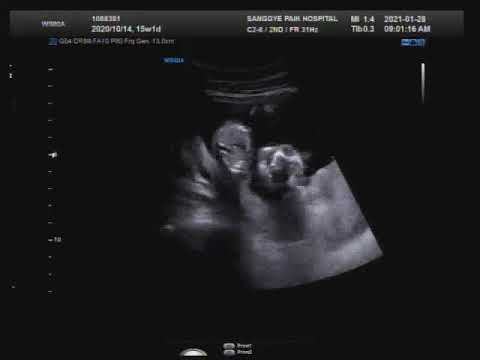 15weeks pregnant 임신15주초음파