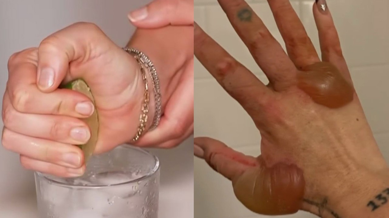 Woman Suffers 'Margarita Burn' On Her Hands