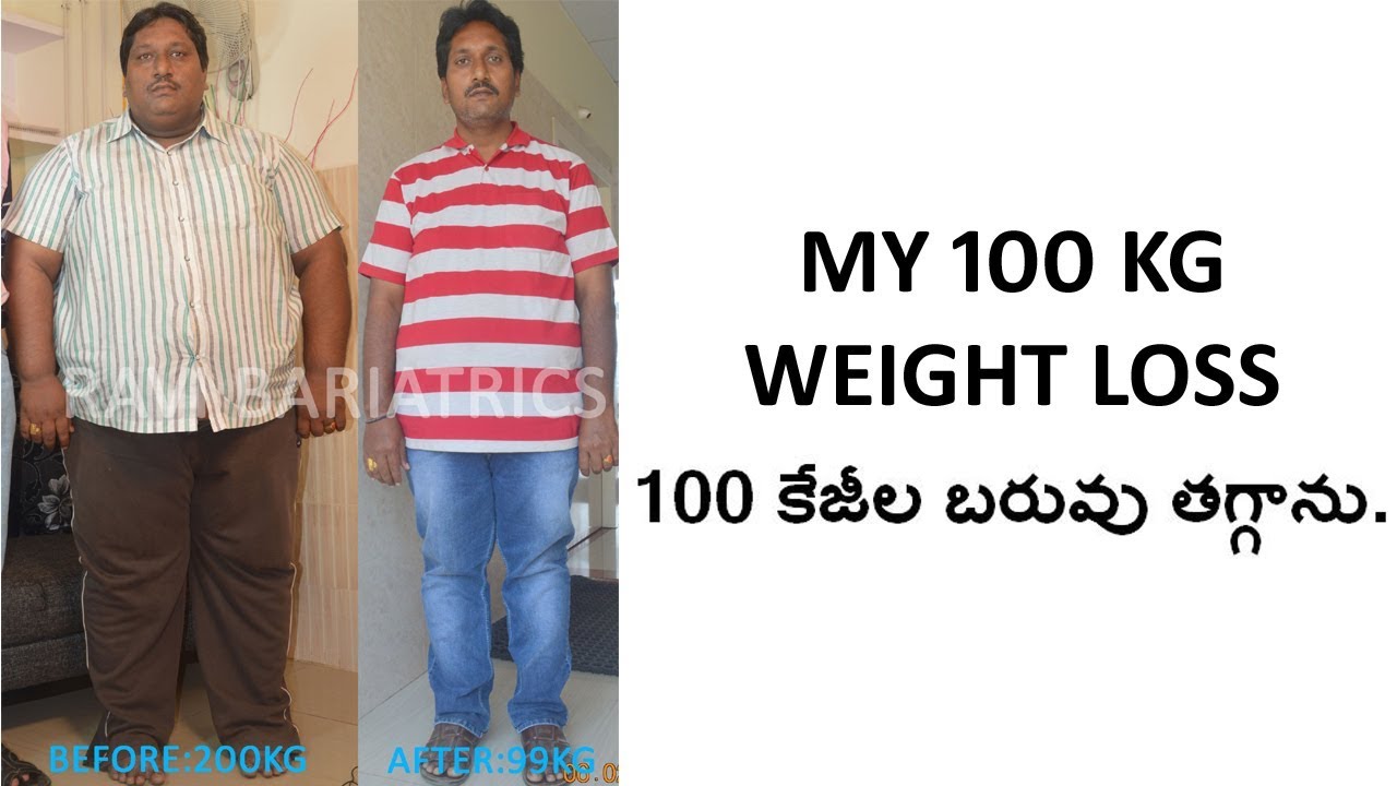 best bariatric surgery results by Dr Ravikanth kongara Hyderabad