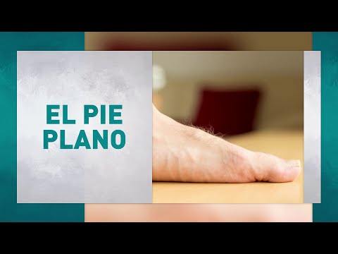 Video: ¿Cómo saber si tienes los pies planos?