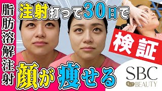 小顔 脂肪溶解注射は金ドブか 本当に小顔になるか試しました 山参注射とエラボトックス Youtube