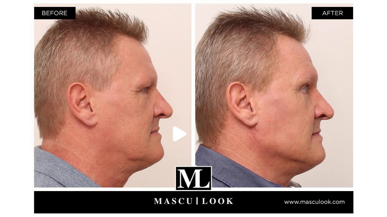Tratamiento de Masculinización Facial o "Mascu Look" - YouTube