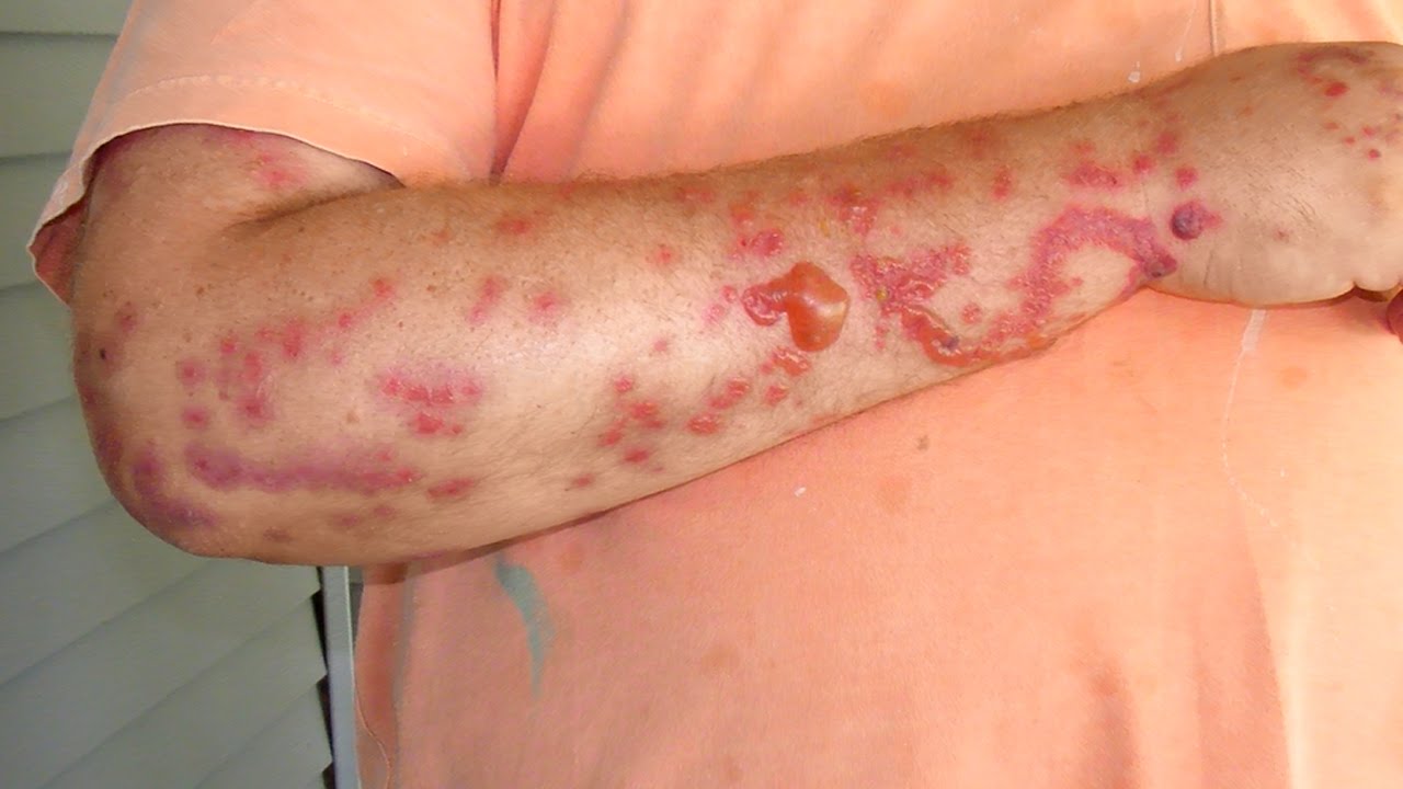 Do I have Bed Bugs? Extreme Parasites! YouTube