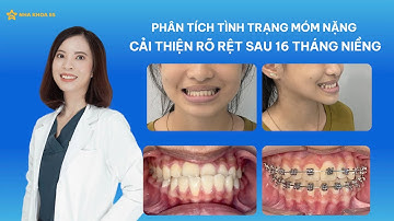 [PHÂN TÍCH CASE NIỀNG RĂNG] MÓM NẶNG - CẢI THIỆN RÕ RỆT SAU 16 THÁNG NIỀNG RĂNG