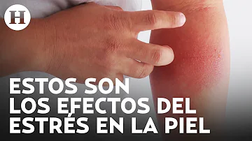 ¿Cómo es la alergia por estrés?