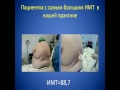 Эпштейн С.Л. "Периоперационная эпидуральная анестезия/анальгезия в хирургии морбидного ожирения"