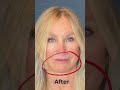 The facelift transformation that turns back time