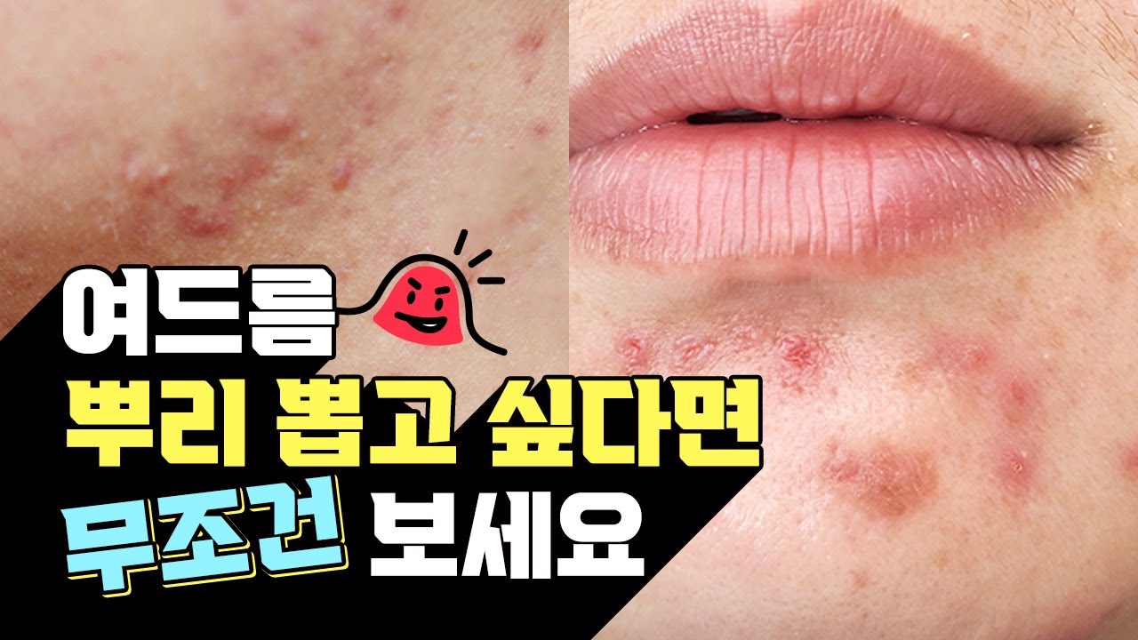 별내피부과 여드름 치료를 잘하는 피부과 여드름 재발시 4