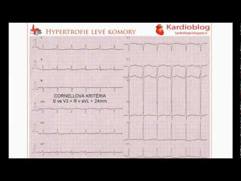 Video: Hypertrofie Levé Komory - Léčba, Příznaky