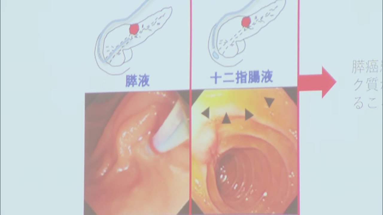 膵臓がん」早期発見へ 世界初の新たなスクリーニング法を開発 胃の内視