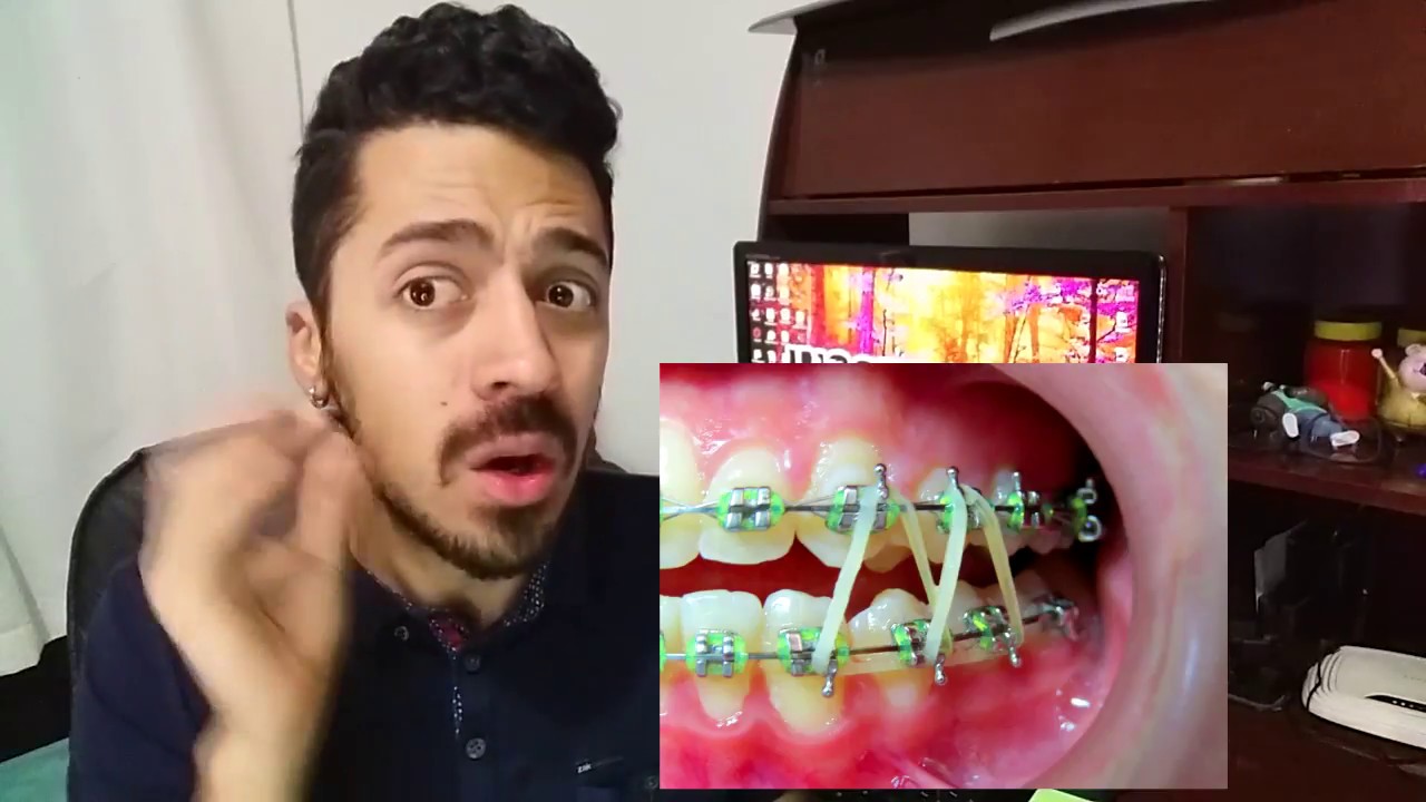 QUAL A IMPORTÂNCIA DOS ELÁSTICOS ORTODÔNTICOS NO APARELHO DENTAL YouTube