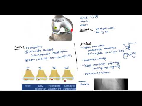 USMLE ਲਈ Osteochondritis ਅਤੇ Osgood Schlatter