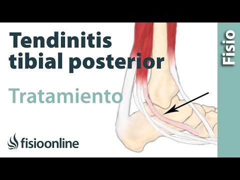 Tendinitis del tibial posterior. Tratamiento con ejercicios de fisioterapia.