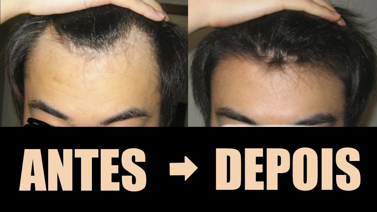 Minoxidil Kirkland A   ntes e depois - Cabelo - Tratamento 5