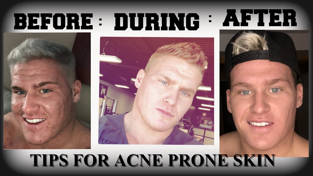 My Acne Skin Care Routine And Tips | *950 dollars a month* - YouTube
