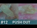 #12 Push Out(Squeezing)Blackheads Close up | ピンセットで角栓を押し出し除去