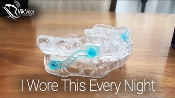 My Honest Review After 4 Months Using a Mandibular Advancement Device (MAD)