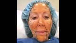 Stem Cell Lift - Face Sterilized and Numbed Stem Cell Lift - Face Sterilized and Numbed