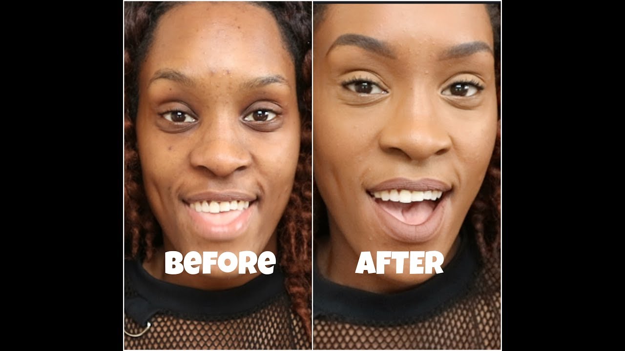 HOW TO COVER HYPERPIGMENTATION AND ACNE SCARS | Dark Skin - YouTube