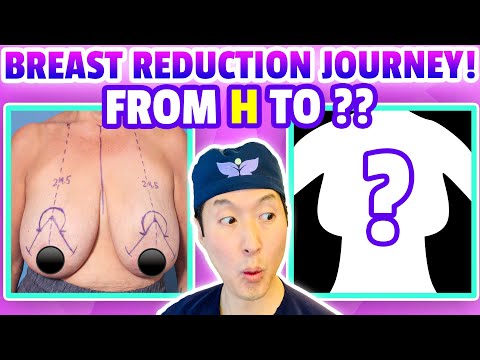 How She Went From an H Cup to a ?? One Woman's Breast Reduction Journey! -  Dr. Anthony Youn 